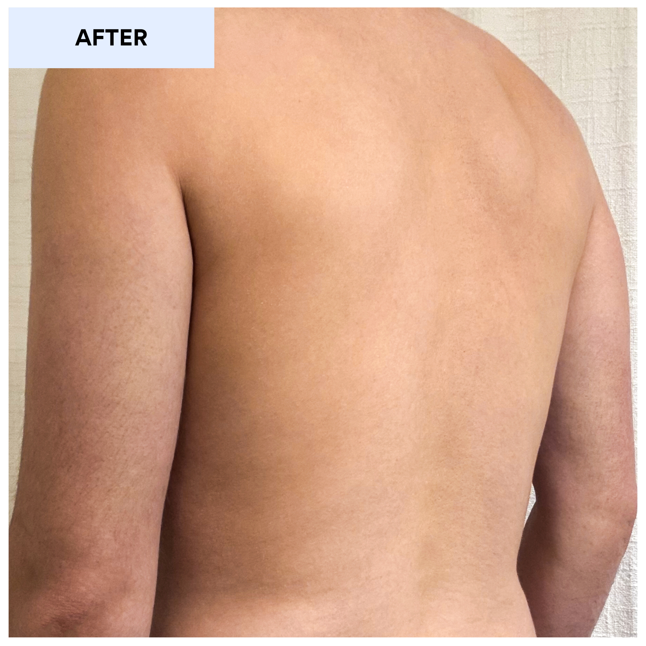 Tinea Versicolor Treatment After