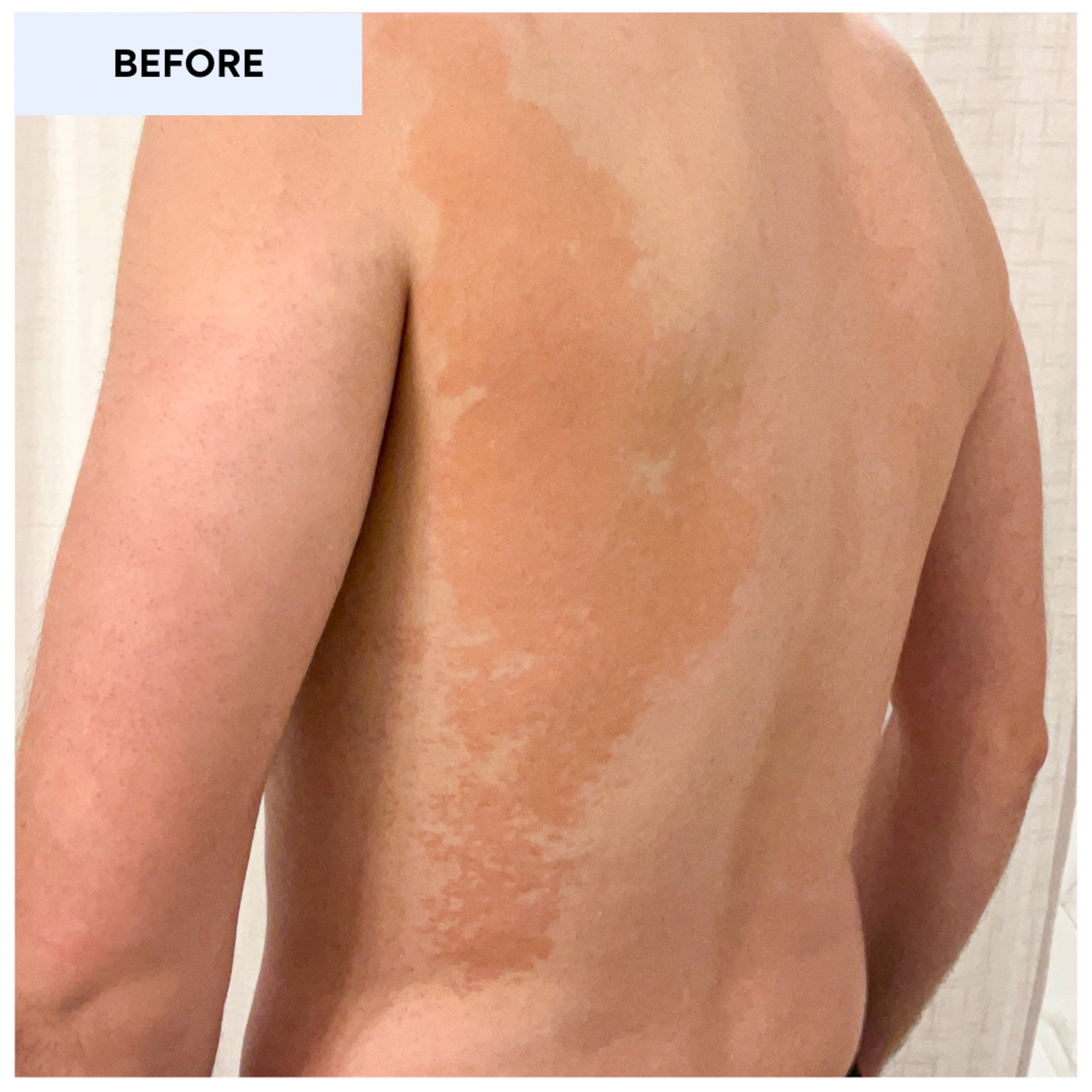 Tinea Versicolor Treatment Before